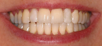 Invisalign, whitening, bonding after 119940
