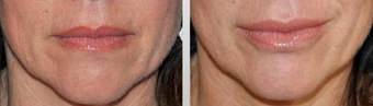 Lip Augmentation before 167637