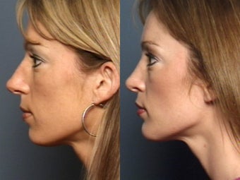 Nose Surgery 338485