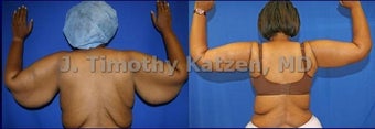 Before and after picture arm lift arm reduction after massive weight loss gastric bypass female african american back view before 644252