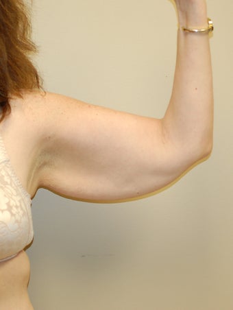 Brachioplasty before 319823