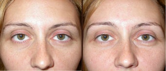 filler to under eye-cheek before 506298