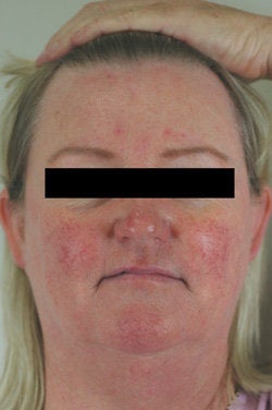Rosacea and Facial Spider Veins before 106541