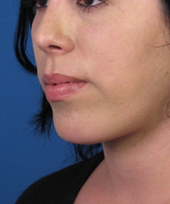 Chin Implant after 534045