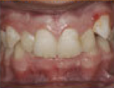 Damon System Braces 477176