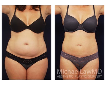 Liposuction before 397106