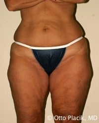 Thigh and Buttock Lift before 566621