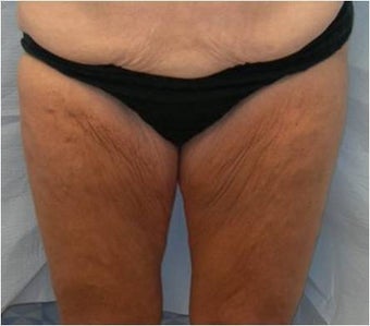 Thigh lift before 589904