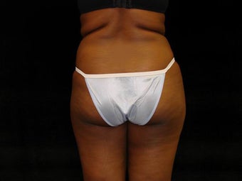 Buttocks Augmentation by Fat Grafting before 157756