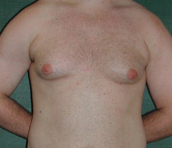 Gynecomastia treated by Liposuction before 117049