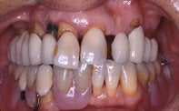 Dental Implants before 510605