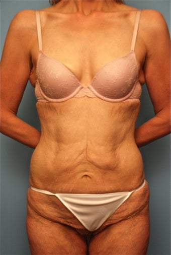 Tummy Tuck without muscle tightening before 259127