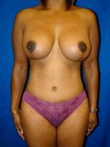 Extended Tummy Tuck with Breast Lift and Implants after 147813