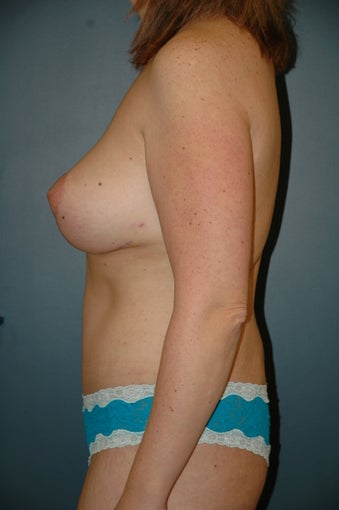 Mommy makeover after 236173