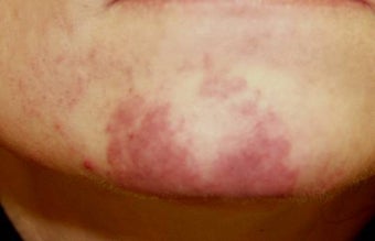 Vascular malformations or birthmarks before 136698