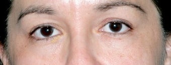 Latisse for Eyelashes before 374415
