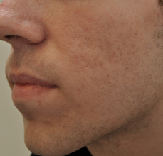 Acne Scarring 426025