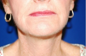 Facelift, Intense Pulsed Light after 132103