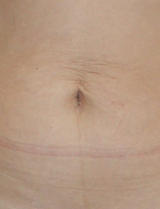 Belly Buttons after Tummy Tuck Surgery before 133867