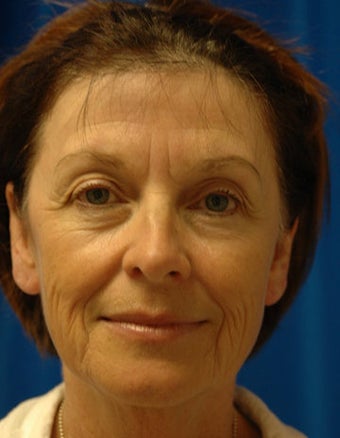 Facelift, Forehead and Eyelid Lift Surgery before 121719