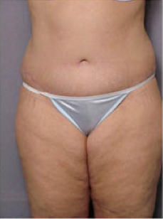 Adominoplasty after 428195