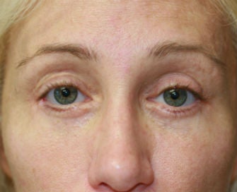 Eyelid rejuvenation after 378928