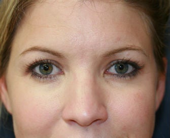 blepharoplasty after 568987