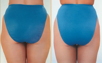 Liposuction before 270019