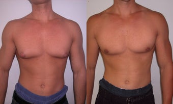 Gynecomastia before 341117