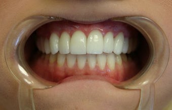 Upper arch make over with veneers and crowns after 625407