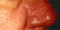Severe Acne Rosacea after 272034