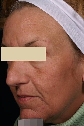 Fraxel after 135908