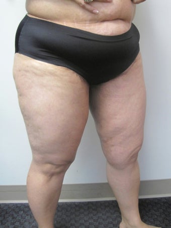 Inner Thigh Lift after 328655