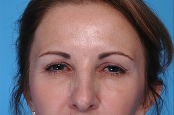 Botox after 506653