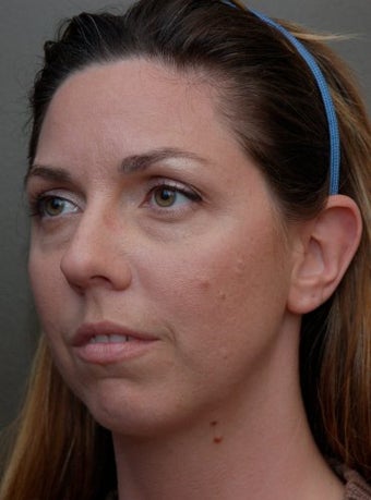 Chin Augmentation Surgery, Non-Surgical Under Eye Dermafillers before 136234