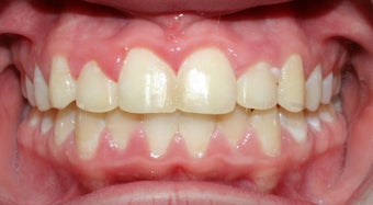 Teen Orthodontic Treatment (case #1RL) after 224710