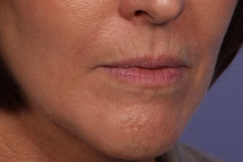 Botox and Juvederm Ultra Plus to Upper Lip 308354