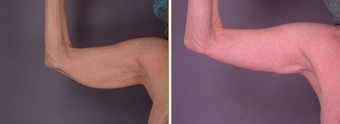 Arm Lift before 272285