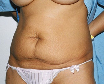 Abdominoplasty (Tummy Tuck) before 216676
