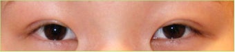 Asian Double Eyelid Surgery - Asian Blepharoplasty after 166204