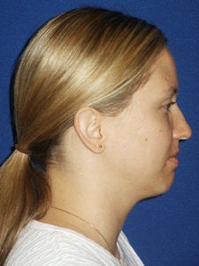 Chin implant Exchange for a more contemporary size medium chin implant and Necklift with 15cc of VASER liposuction of the neck. before 250170