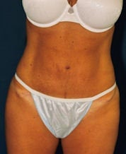Tummy Tuck after 634288