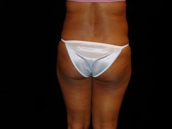 Buttocks Augmentation before 517504