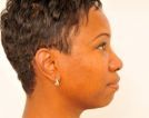 Chin Augmentation 379502