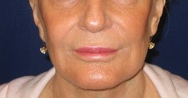 Restylane injection into lips and nasolabial folds after 109944