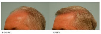 Hair Transplant after 140427