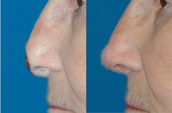 Nasal Reconstruction after Mohs Surgery before 597129