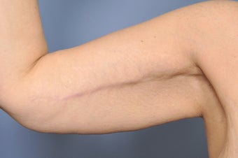 Arm Lift 544868