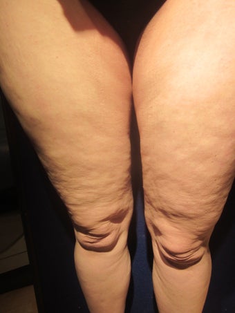 Cellulaze before 589900