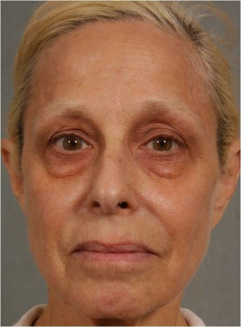 60 Year Old Female treated for under eye puffiness, sagging cheeks and frown lines non surgically before 640083